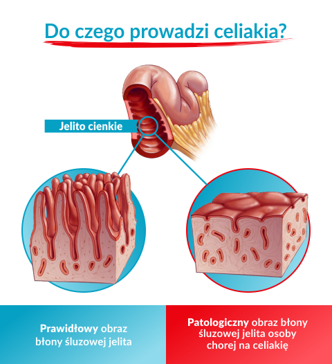 celiakia u dzieci, objawy celiakii u dzieci, celiakia u dziecka